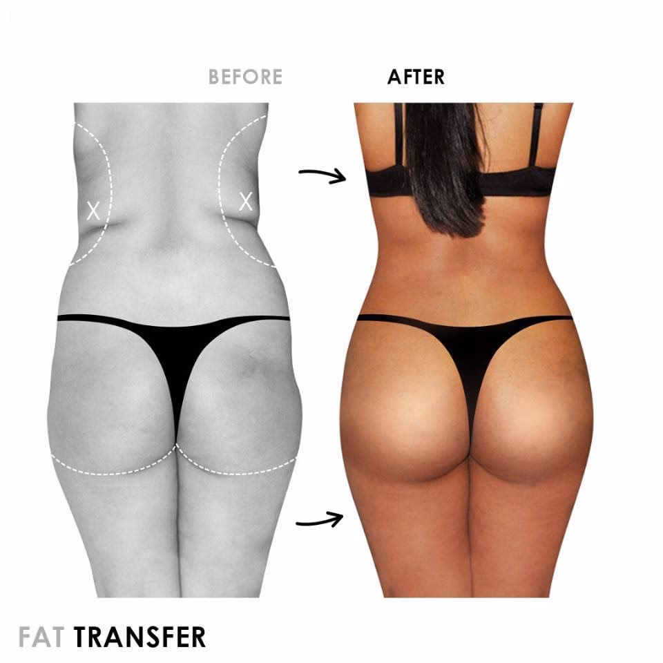 What is a buttock augmentation?