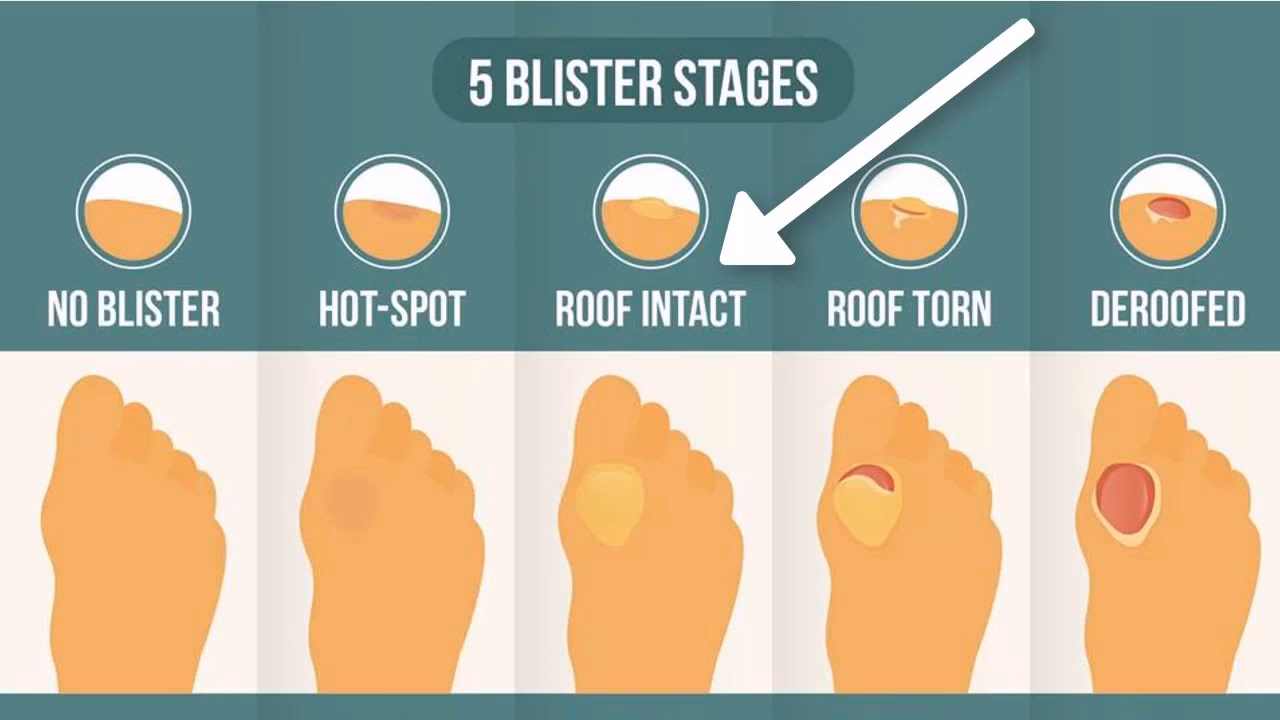 Can a friction Blister Pop on its own?