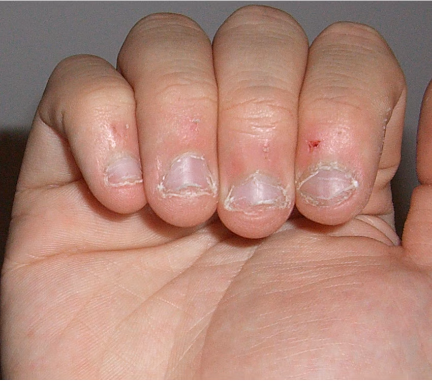 Is nail biting a bad habit?
