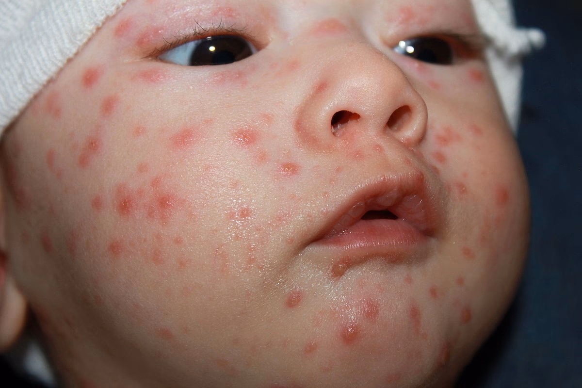 Where can I find a translation of chickenpox?