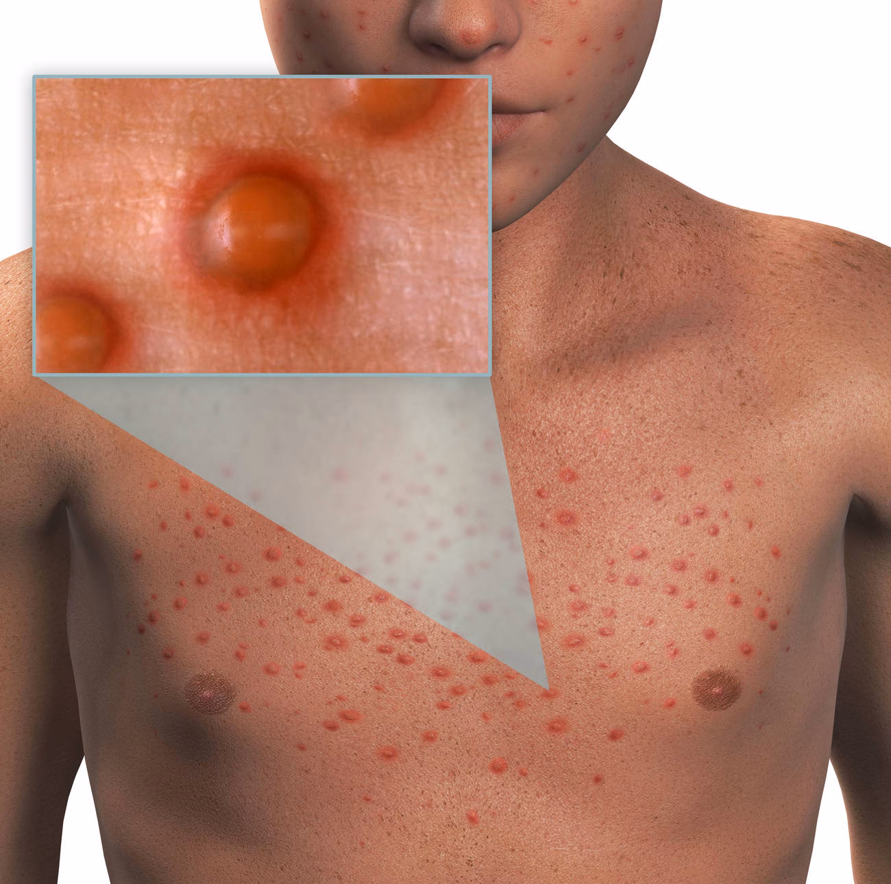 What symptoms does chickenpox cause?