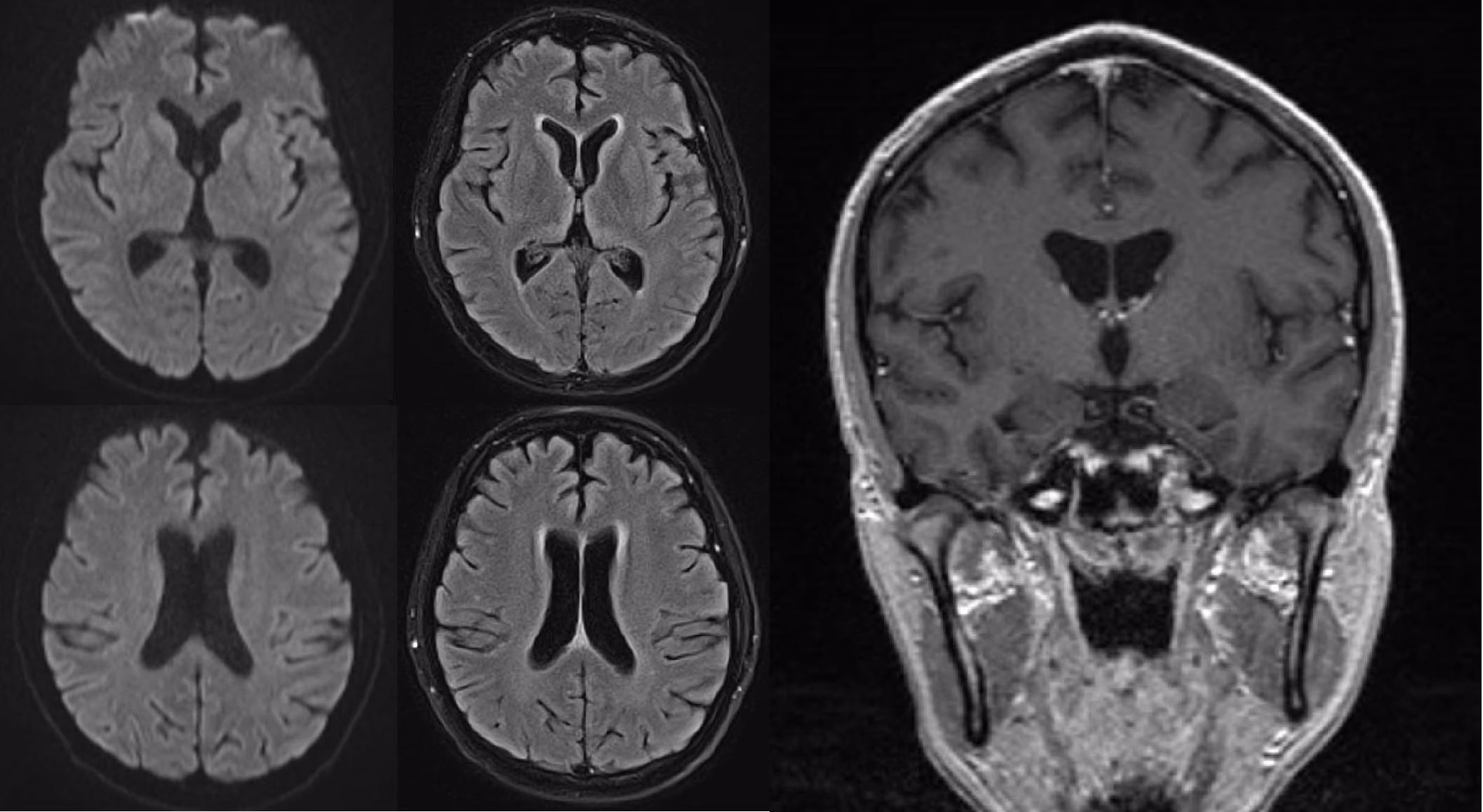 Is there a fatal familial insomnia (FFI) in the Netherlands?