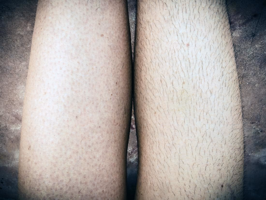 Can you lose hair from your legs?