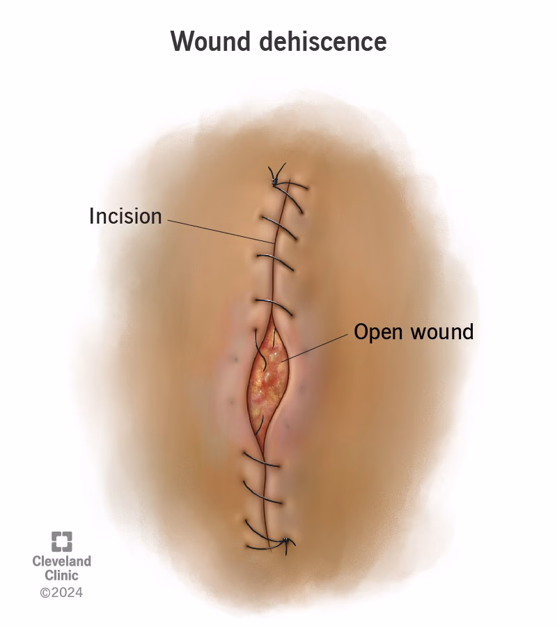What is a surgical incision?
