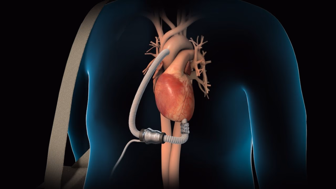 Does myocardial muscle mass affect left ventricle power?