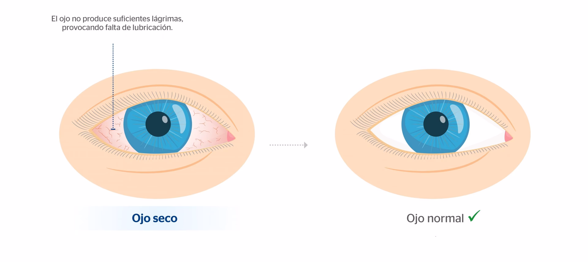 ¿Cuáles son los síntomas del síndrome de ojo seco al despertar?