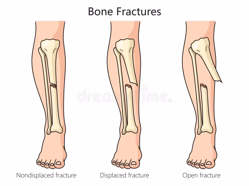 What is an open or compound fracture or dislocation?
