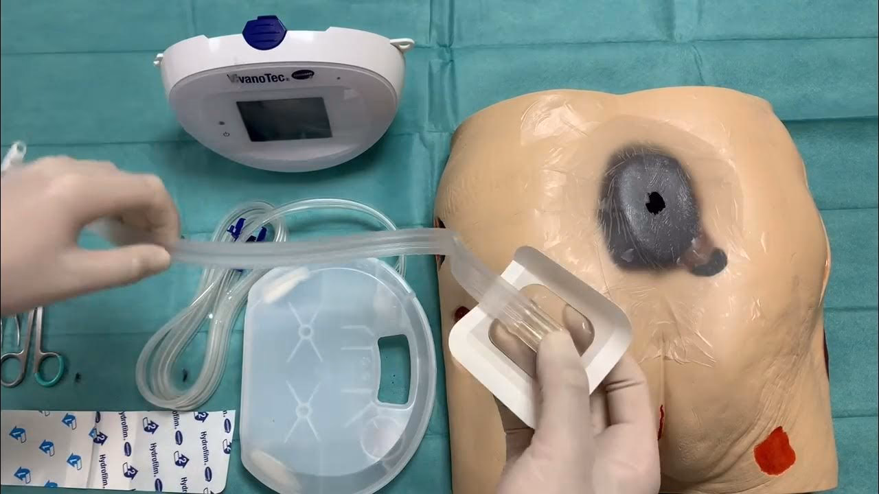 ¿Qué es la terapia VAC?