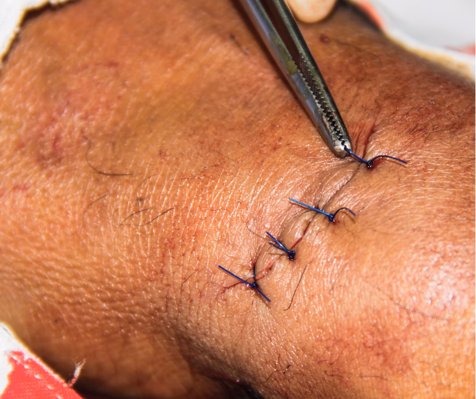 How do I learn how to suture wounds?